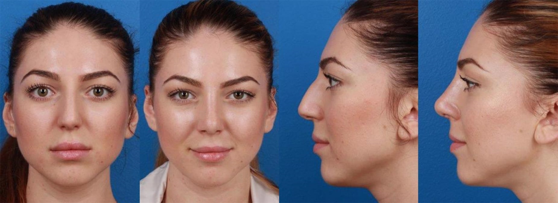 best revision rhinoplasty surgeon in the world