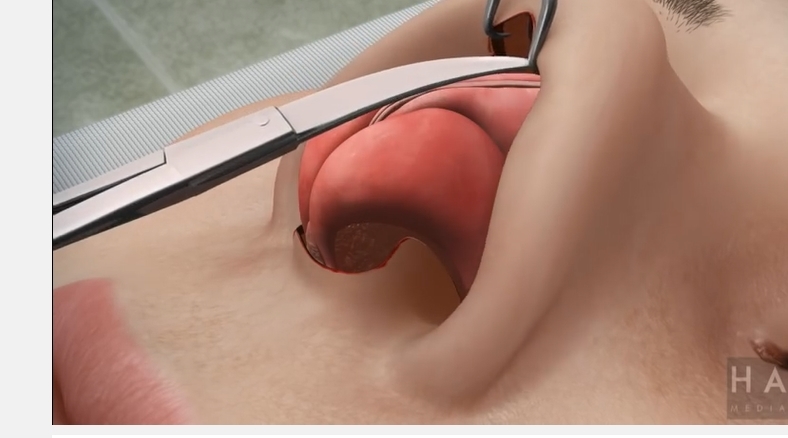 wpid-rhinoplasty-animation-3.jpg